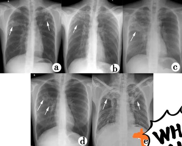 肺结核的分型诊断标准，肺结核的分型及影像学表现