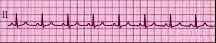 一分钟快速看懂心电图，1分钟教你看懂心电图