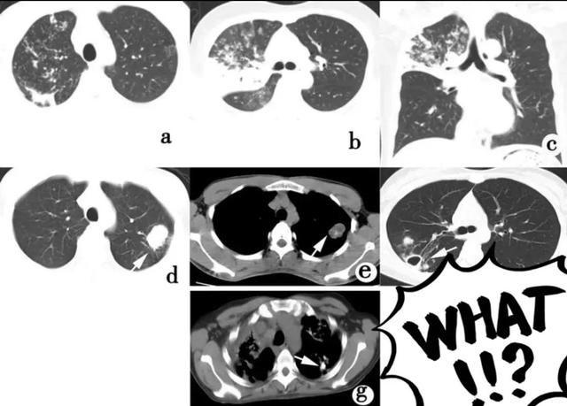 肺结核的分型诊断标准，肺结核的分型及影像学表现