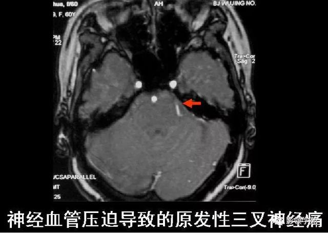 面部血管分布图，三叉神经分支及面部分布规律（玻尿酸怎么打，才会避免栓塞呢）