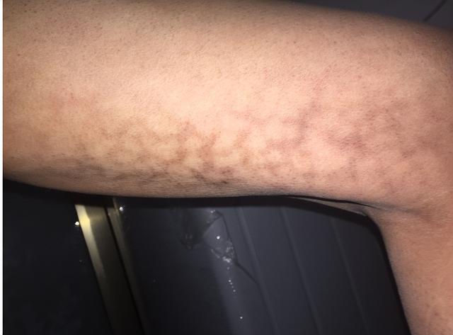肥胖大腿根黑色素(胖人大腿根黑怎么回事)