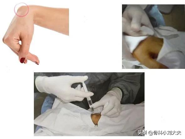 手背腱鞘囊肿图片，手背腱鞘囊肿自愈最佳方法（手背上凸起的肿块被我捏瘪了）