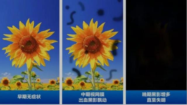 糖尿病盲了(糖尿病瞎了能活多久)