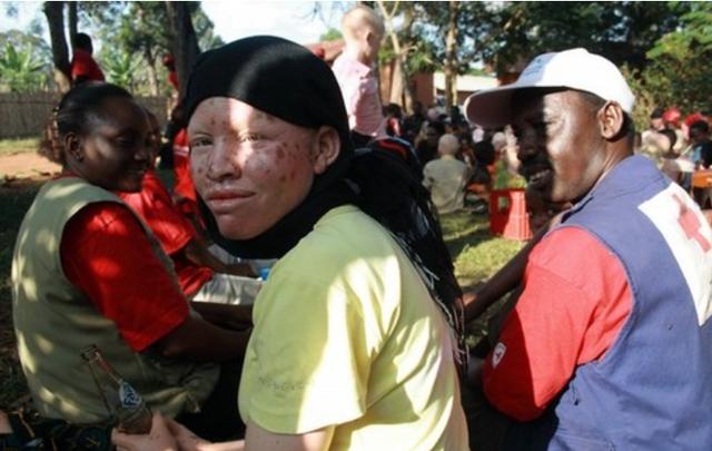 人类白化病的直接原因，非洲的白化病人