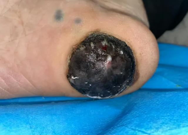 突然长黑色肉痣是什么原因，皮肤上这种痣十有八九是黑斑息肉
