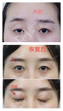 大小眼自我矫正方法，大小眼矫正方法（如何矫正大小眼）