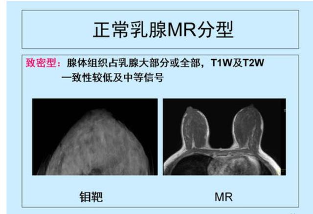 怎么预防乳腺癌，大多数女性都不知道（怎么样分辨乳腺癌是早期和晚期）