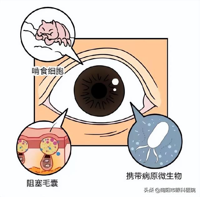 眼螨虫病的症状和治疗，眼表病专家张爽告诉您