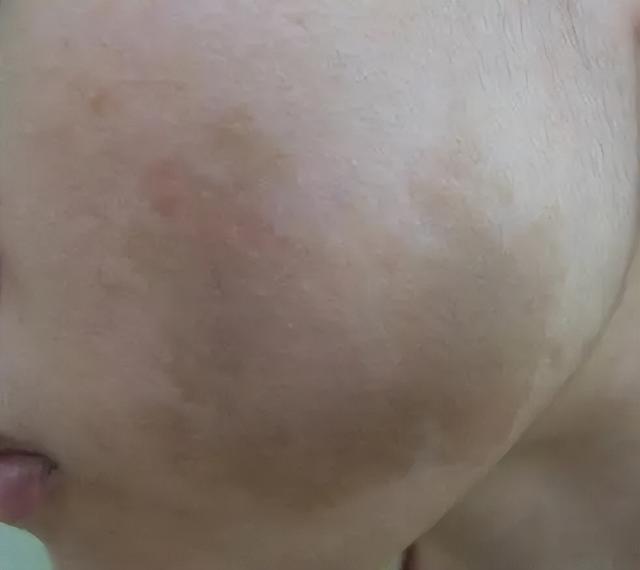 牛奶咖啡斑如何去除肥胖(牛奶咖啡斑能自行消退吗)