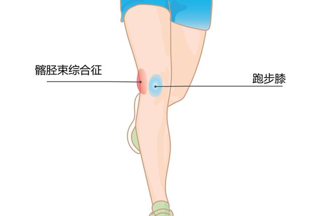 髌腱炎会自愈吗，跑步膝盖滑囊炎还能跑吗（骨关节炎的可能性有多大）