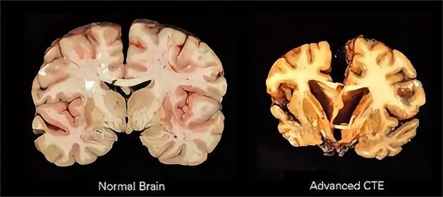 致死率达100烹煮都杀不死的朊病毒，朊病毒到底是什么病毒
