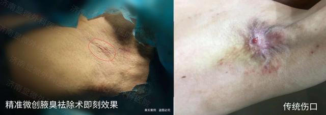 跑步可以减少腋臭吗女生(跑步腋窝出汗能排湿吗)