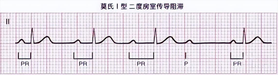 一分钟快速看懂心电图，1分钟教你看懂心电图