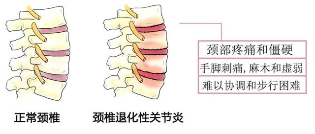 肩颈酸痛的厉害是什么原因，五大原因六大方法来缓解