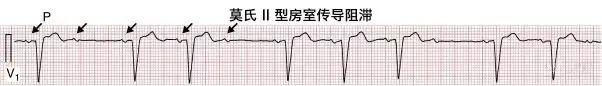 一分钟快速看懂心电图，1分钟教你看懂心电图