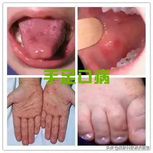 手足口病的主要症状怎么治疗好，手足口病的症状及治疗注意事项