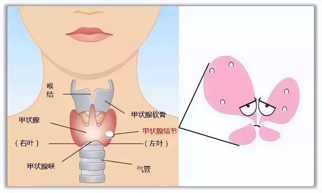 甲状腺结节糖尿病(甲状腺结节糖尿病能手术吗)
