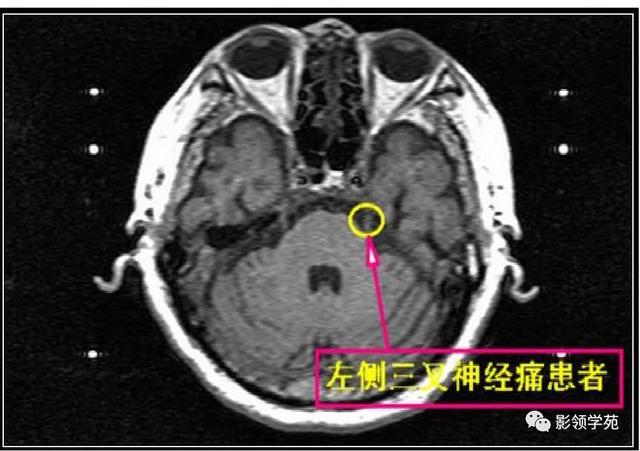 面部血管分布图，三叉神经分支及面部分布规律（玻尿酸怎么打，才会避免栓塞呢）