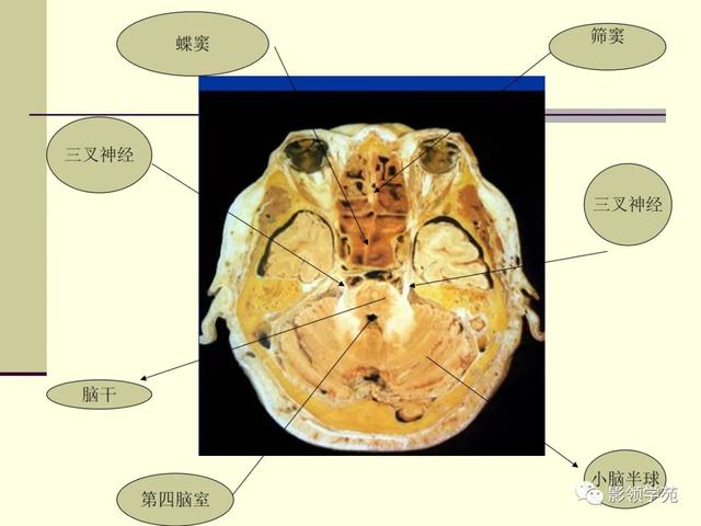 面部血管分布图，三叉神经分支及面部分布规律（玻尿酸怎么打，才会避免栓塞呢）