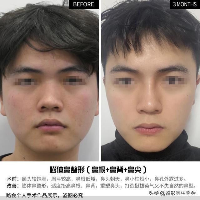 男子隆鼻一年后的真实感受，男子花1.2万隆鼻后竟能晃动