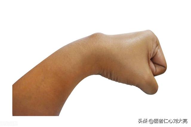 手背腱鞘囊肿图片，手背腱鞘囊肿自愈最佳方法（手背上凸起的肿块被我捏瘪了）