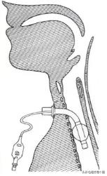 正常人的声带图片，喉咙切开插管能说话吗（关于喉头、声带的10个秘密）
