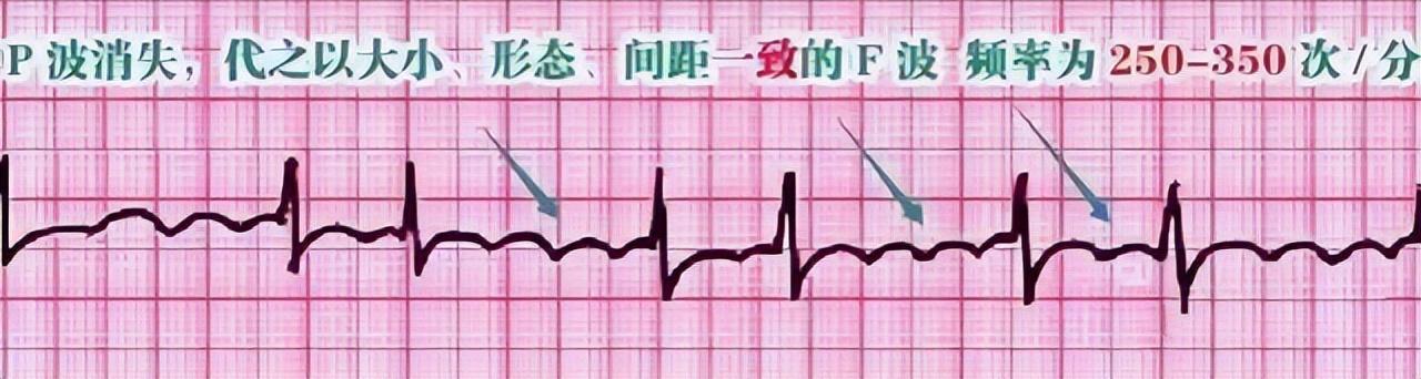 一分钟快速看懂心电图，1分钟教你看懂心电图