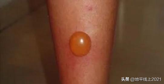 被蚊子咬了红肿特别大怎么办，蚊虫叮咬起大包（蚊虫叮咬起了大包怎么办不过血了）