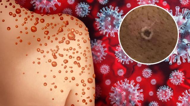 美国的猴痘是因为什么引起的，美国祸不单行