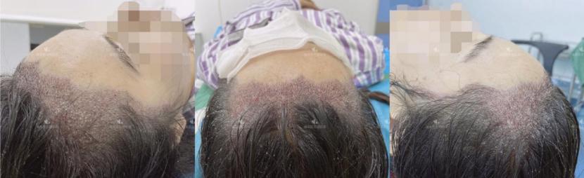 一图解析植发手术全流程，揭秘植发手术的全过程