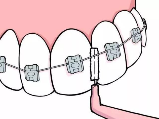 戴牙套后必须要注意的，戴上牙套后如何做好日常护理