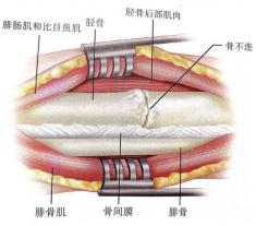 糖尿病骨不连(糖尿病骨瘦如柴为什么没有并发症)