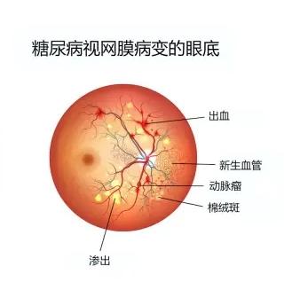 糖尿病眼瞎了(糖尿病眼瞎了还能活多久)