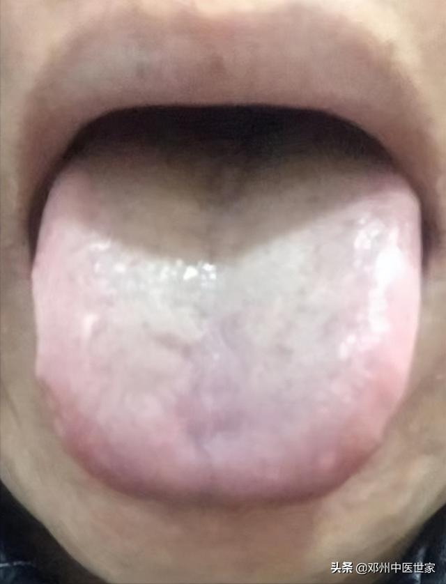 脾虚湿盛型肥胖病(脾虚湿盛型肥胖怎么调理)
