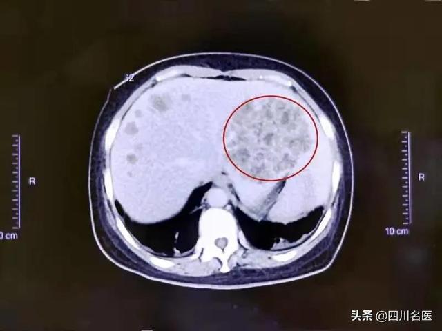 肥胖长脓包(胖子有脓点吃什么药)