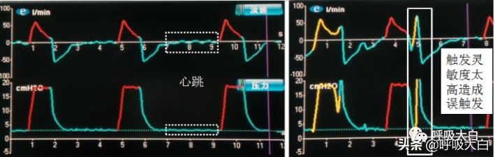 5个呼吸机常见参数设置，呼吸机各种模式需要调的参数（送给临床小白——呼吸机模式及参数设置图文详解）