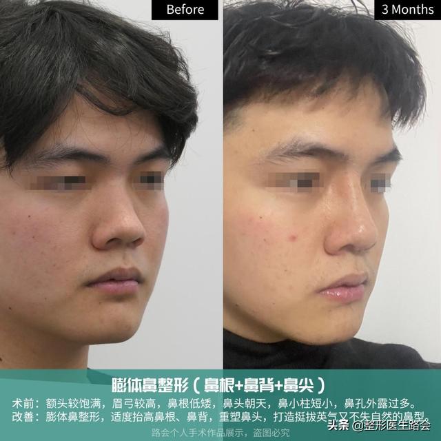 男子隆鼻一年后的真实感受，男子花1.2万隆鼻后竟能晃动