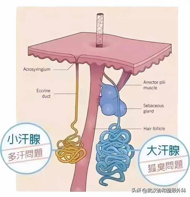 腋臭手术切除的是什么部位(腋臭手术切除的疤痕图片)