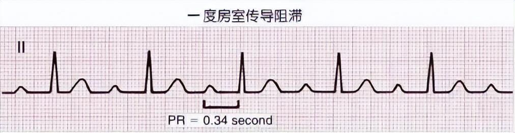 一分钟快速看懂心电图，1分钟教你看懂心电图