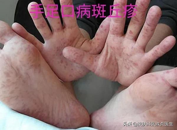 手足口病的主要症状怎么治疗好，手足口病的症状及治疗注意事项