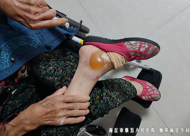 糖尿病尿尿起泡(糖尿病尿液起泡泡怎么治疗)