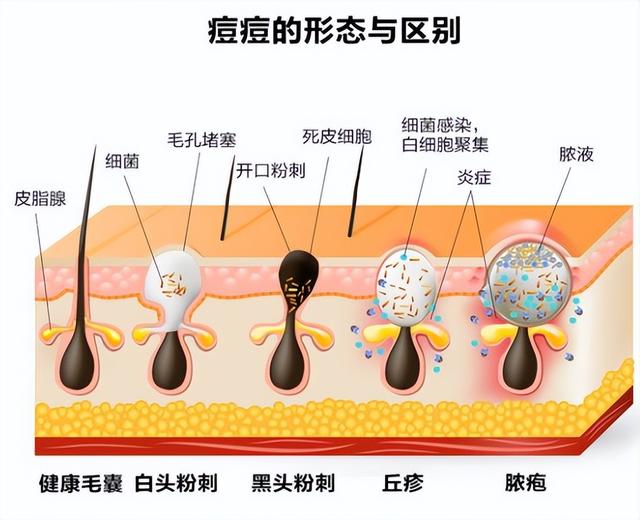 糖尿病挫窗(糖尿病p)