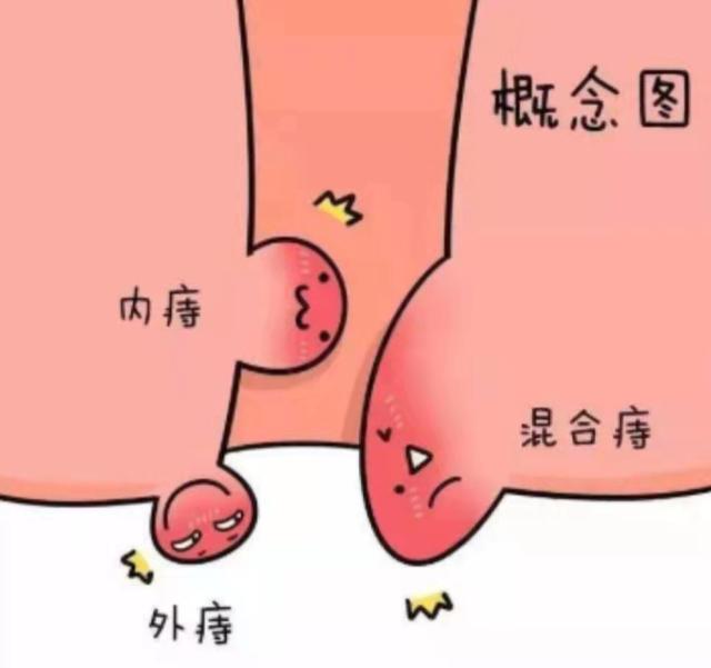 肥胖痔(肥胖痔疮)