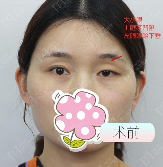大小眼自我矫正方法，大小眼矫正方法（如何矫正大小眼）