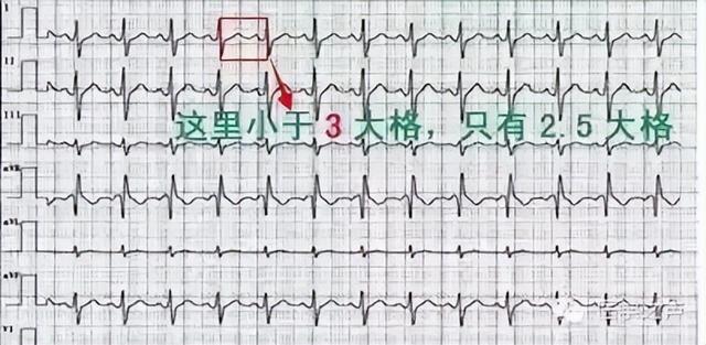 一分钟快速看懂心电图，1分钟教你看懂心电图