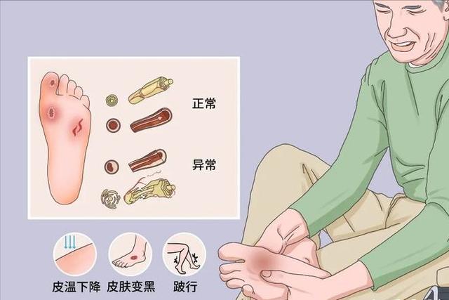 糖尿病足诊断标准(糖尿病足的确诊)