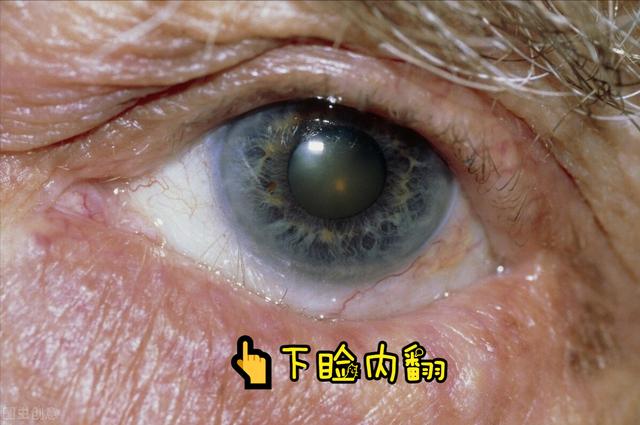 眼睑的位置图片，从上眼睑可以看出身体病症吗