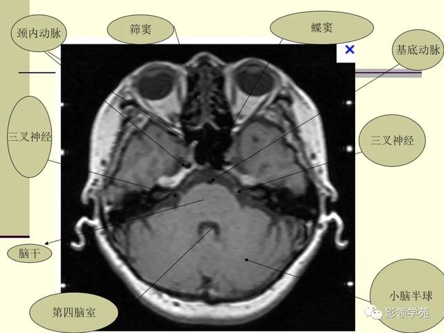 面部血管分布图，三叉神经分支及面部分布规律（玻尿酸怎么打，才会避免栓塞呢）