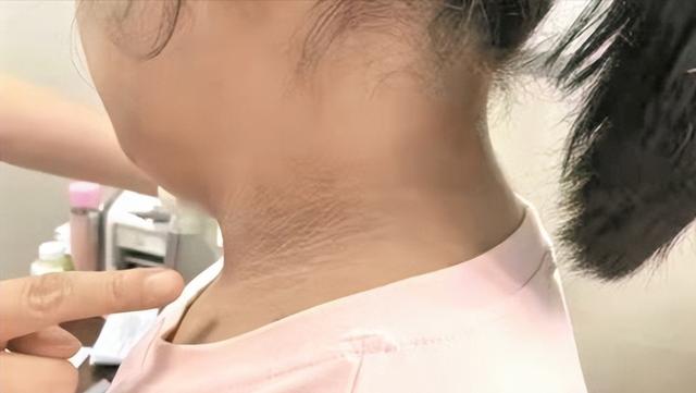 肥胖型黑棘皮图片(肥胖型黑棘皮病怎么治疗)