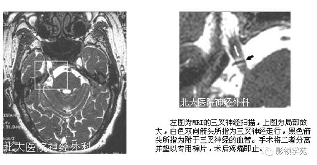 面部血管分布图，三叉神经分支及面部分布规律（玻尿酸怎么打，才会避免栓塞呢）